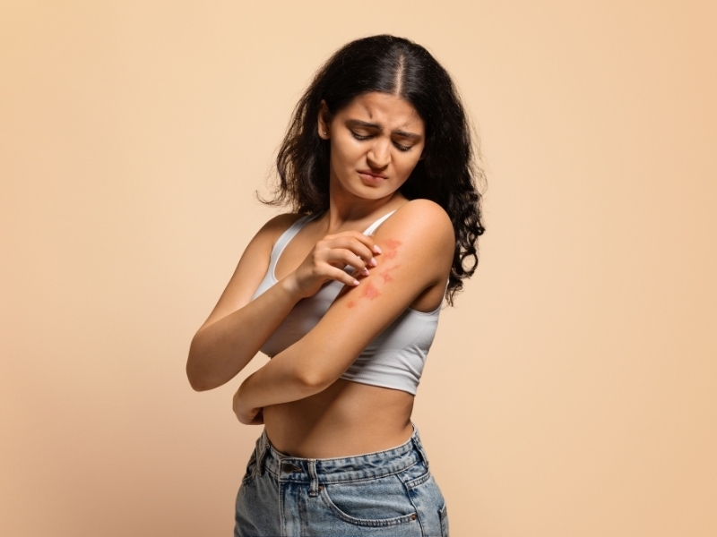 psoriasis